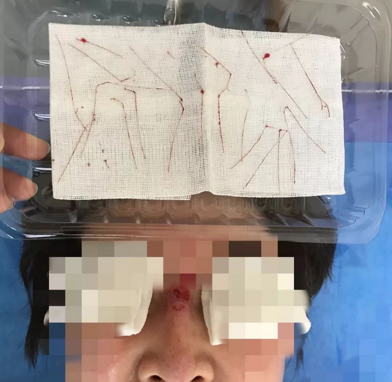 女子鼻子起个脓包 手术后竟然取出十条线